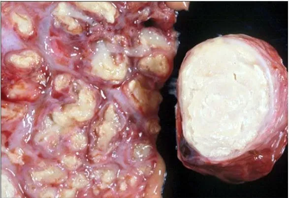 Pulmão e linfonodo bovino com diversos nódulos de aspecto caseoso
