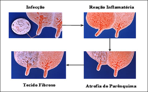 Lesões na glândula mamária provocadas pela mastite