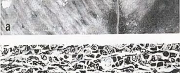 Doença do músculo branco