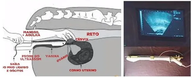 Aspiração folicular guiada por ultrassom