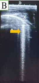 Imagens ultrassonográficas de "cauda cometa"
