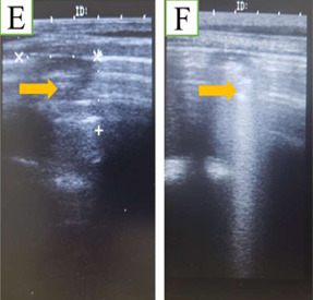 Imagens ultrassonográficas com consolidação pulmonares