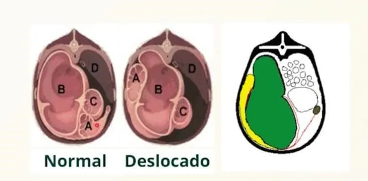 Visão de um corte transversal de uma vaca com e sem deslocamento de abomaso
