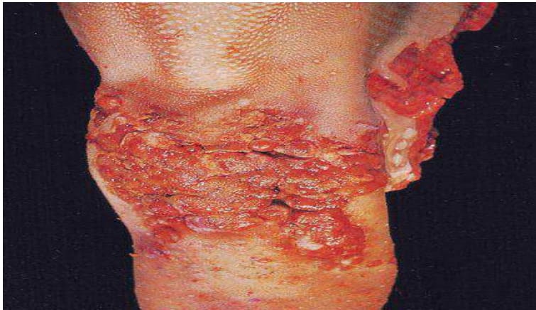 Quadro clínico de actinobacilose causando a "língua de pau"